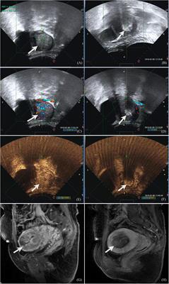 Treatment of Placenta Increta With High-Intensity Focused Ultrasound Ablation and Leaving the Placenta in situ: A Multicenter Comparative Study